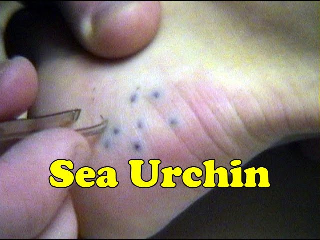 Sea Urchin Sting Removal Maui Hawaii - Daredevil Girl