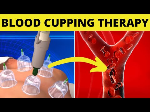 Interesting Health Benefits of Blood Cupping Therapy | Increase Blood Circulation | Think Good