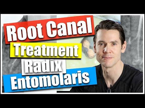 Root Canal Treatment - Radix Entomolaris