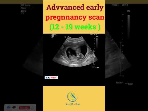 Advanced earlypregnnancy scan (12 - 19 weeks ) #baby #pregnancy #pregnant #birth #babies