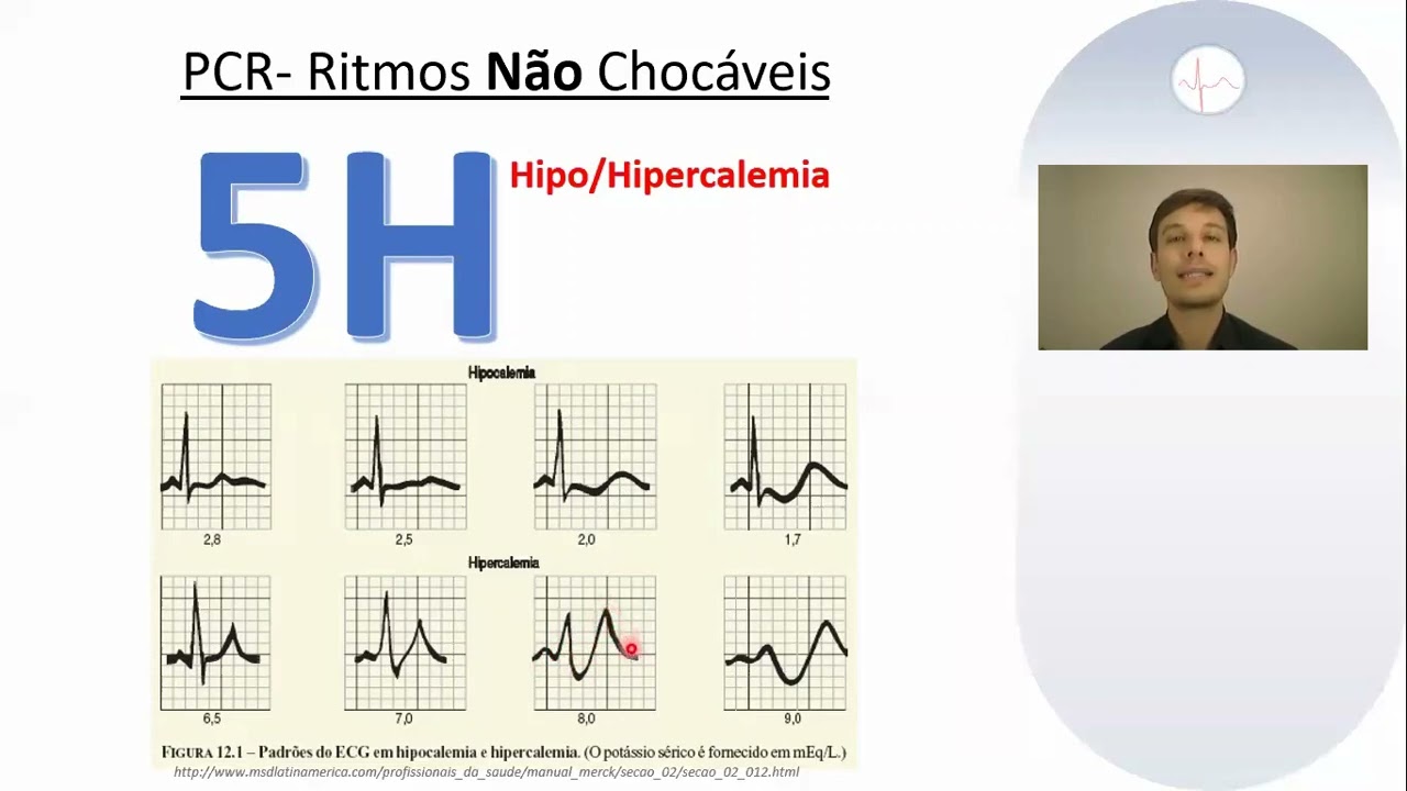 ECG e o ACLS: Alterações durante PCR e pré PCR