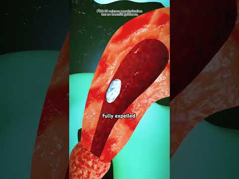 Dilation and Curettage (3D Animation)