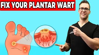 Plantar Warts Removal at Home Treatment  [Foot & Toe Wart Remedies]