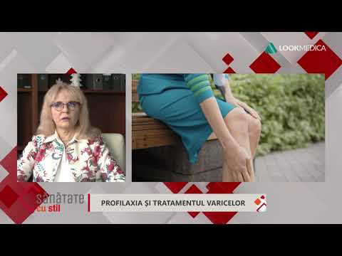 perna de botori din varicoza apa sarata pentru varicoza