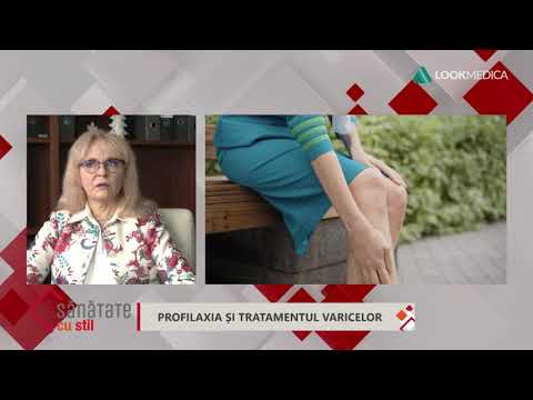 exercitarea de la varicoz cu anita lutsenko)