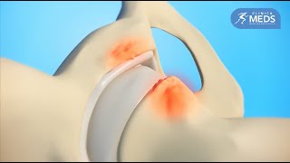 Cirugía artroscópica de cadera