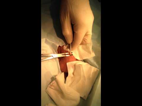 Chirurgie de mărire a penisului în thailanda