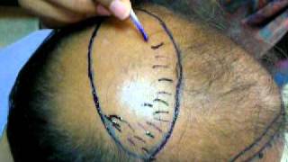 preview picture of video 'Hair Transplant Surgery Gujranwala by Dr.Ahmad Chaudhry MD(Paris)'