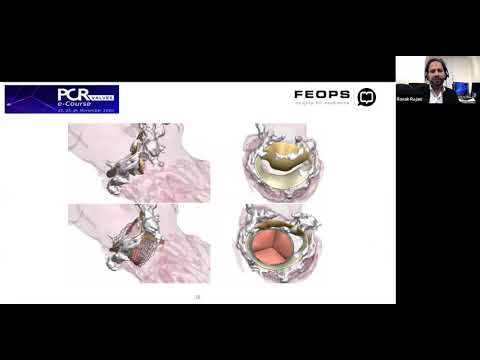 TMVR interventions (MAC) with Prof. Ronak Rajani