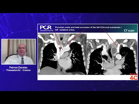 Porcelain aorta, calcified aortic valve, and calcified left main. What comes first? Which valve?