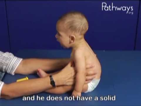 6 Month Olds Babies in Sitting, Typical and Atypical Development Comparison