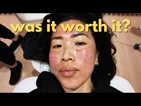 pov: you tried microneedling for acne scarring