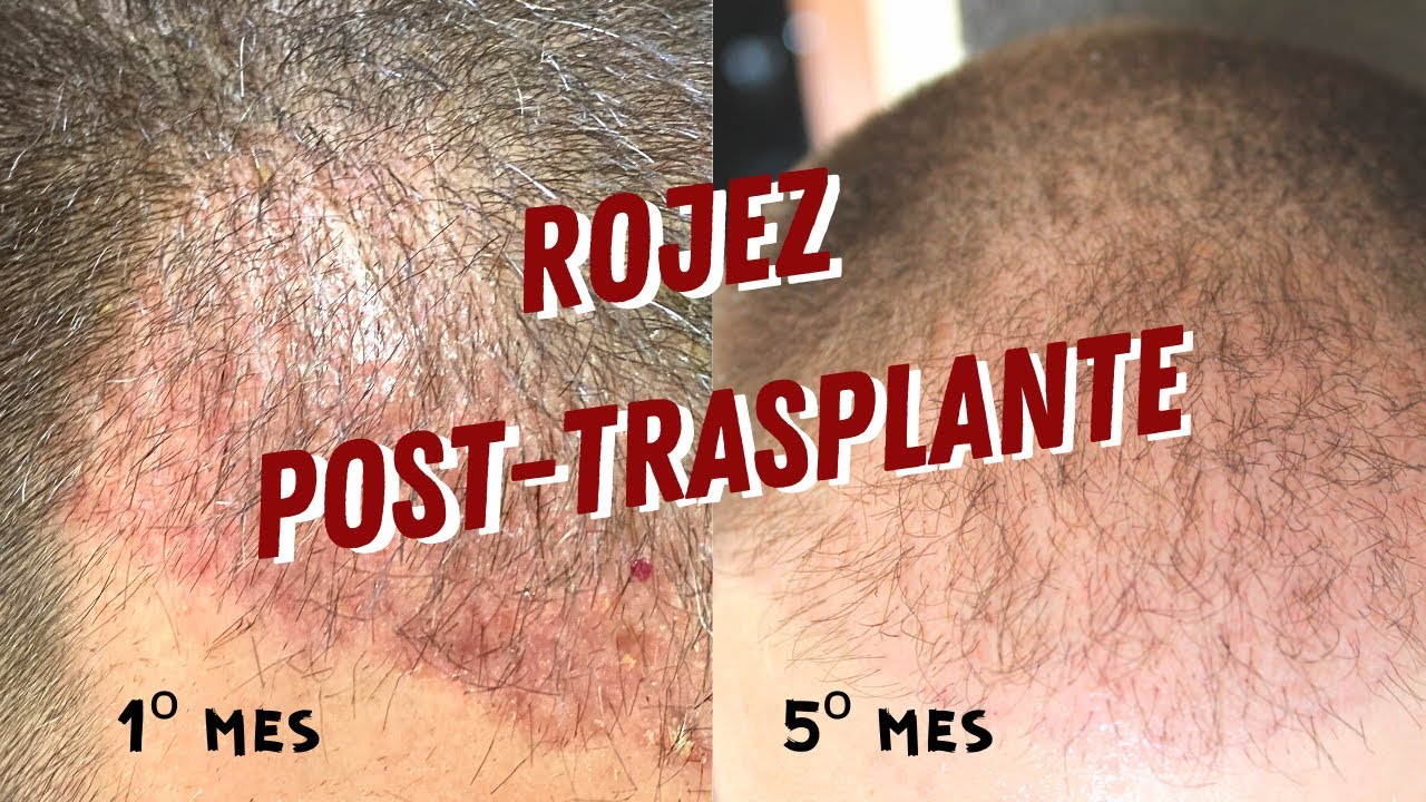 Watch ROJEZ POST TRASPLANTE DE PELO: ¿Cuánto dura ¿se puede eliminar Now ROJEZ POST TRASPLANTE DE PELO: ¿Cuánto dura ¿se puede eliminar