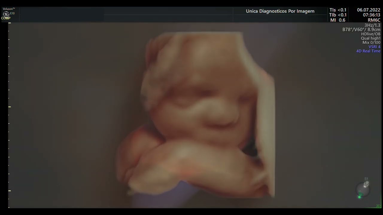 Ultrassom 4D HD Live - 07