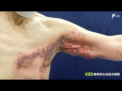 グロボ記者、帯状疱疹診断後に警告、理解