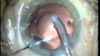 Cirugia de catarata con lente bifocal (mejora de lejos y de cerca)