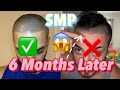 Scalp Micro Pigmentation SMP 6 Month Later Update Video