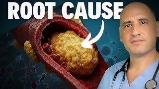 Heart Surgeon’s SHOCKING TRUTH-Cholesterol, Carnivore Diet, & Statins