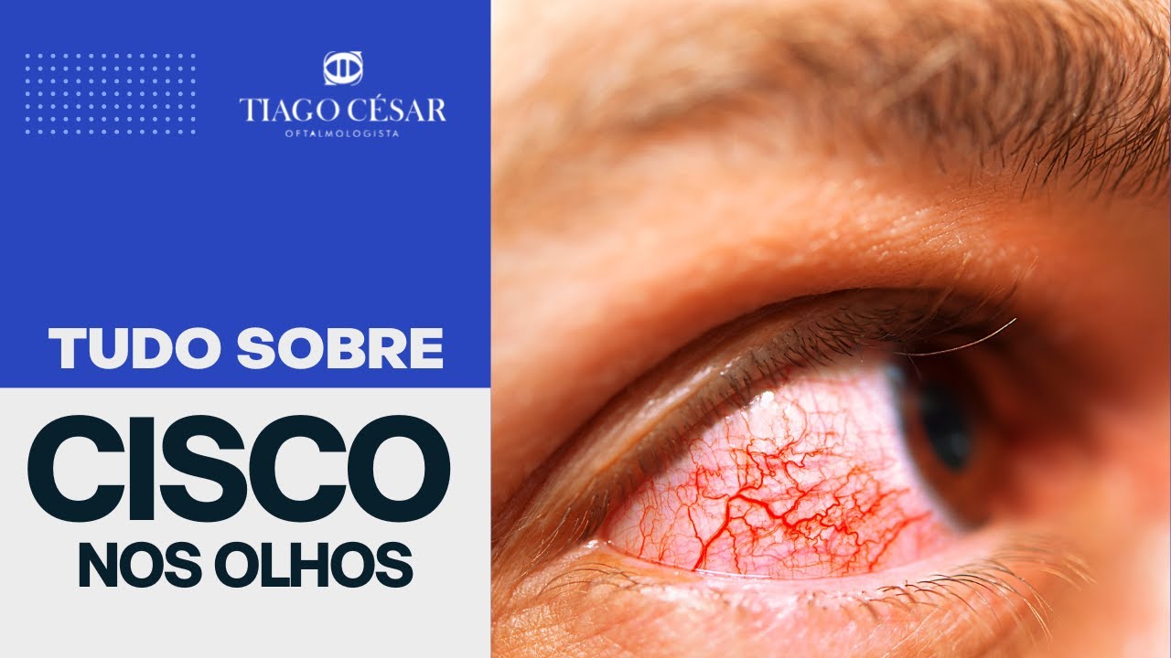 Tudo sobre CISCO nos olhos - Como tirar, limpar e tratar?