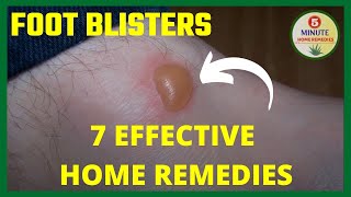 7 Effective Foot blisters Home Remedy | Foot Blister Treatment