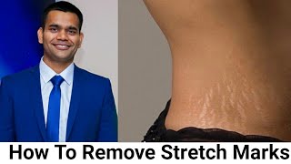 How To Remove Stretch Marks Fast | Home Remedy