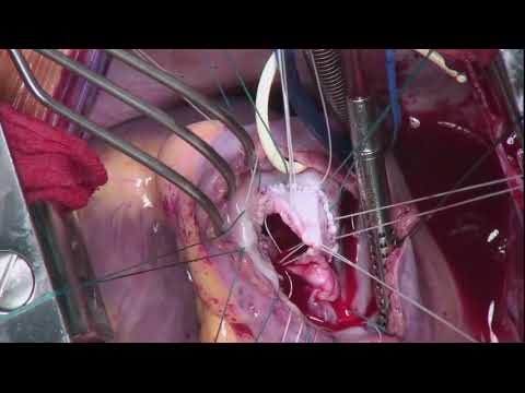 download lagu mp3 mp4 Open Heart S, download lagu Open Heart S gratis, unduh video klip Open Heart S