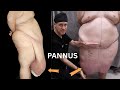 Was Ist Eine Pannikulektomie Alles Was Sie Wissen Müssen