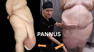 What Is a Panniculectomy? Everything You Need to Know