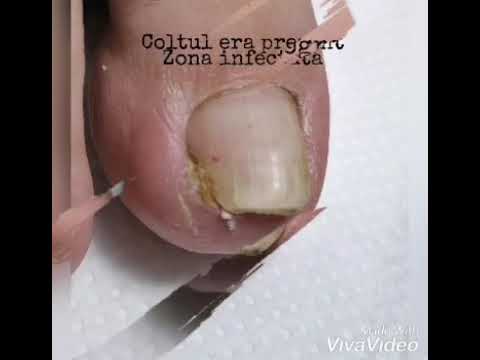 Tratament cu tinctură pentru ciuperca unghiilor
