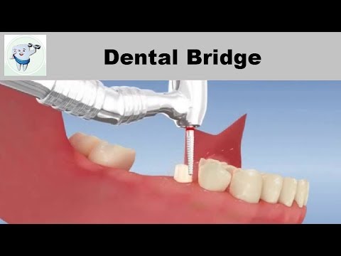 Dental Bridge