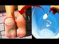 How to Get Rid Of Dry Cracked Heels Permanently Naturally At Home Without Pumice Stone