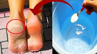 How to Get Rid Of Dry Cracked Heels Permanently Naturally At Home Without Pumice Stone