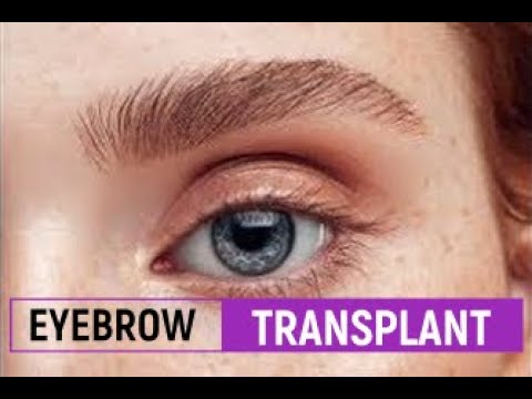 download lagu mp3 mp4 Eyebrow Transplant Before And After, download lagu Eyebrow Transplant Before And After gratis, unduh video klip Eyebrow Transplant Before And After