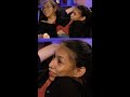 What if one conjoined twin dies?