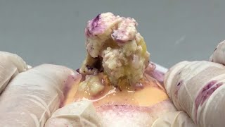 Popping large squeeze acne in young patient explosive inflammation 3490