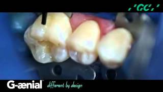 G-ænial: Class I Restoration - Restoring the Posterior Dentition