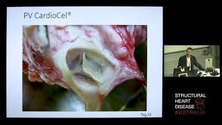 Novel Bioscaffolding used in Right-Sided Valve Reconstruction – A/Prof Christian Brizard