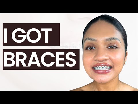 I Finally Got Braces… My Honest Day 1 Experience