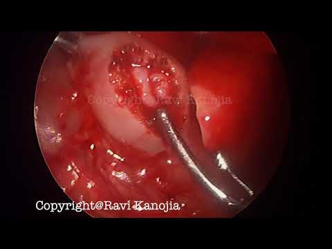 Pyloromiotomia laparoskopowa z powodu przerostowego zwężenia odźwiernika