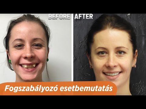 fogszabályozók segíthetnek a fogyásban