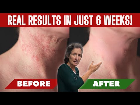 Natural Solutions for Psoriasis and Eczema | Barbara O'Neill