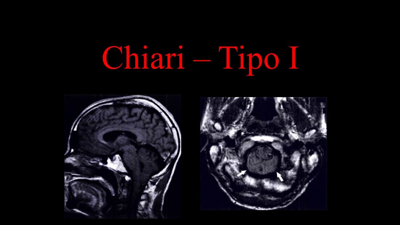Chiari  Tipo I - Malformação (Neuroradiologia)