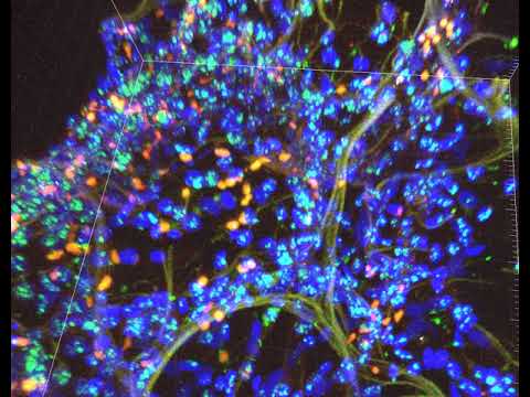 PLISH In situ Hybridization of Thick Human Lung Tissue Cleared in Urea For SFTPC, MIR29-1, and AXIN2