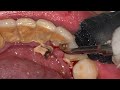 PROSES PEMBERSIHAN KARANG GIGI Dentist Dokter Gigi Tri Putra