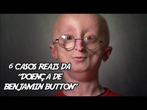 6 Casos Reais da “Doença de Benjamin Button”