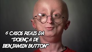 6 Casos Reais da “Doença de Benjamin Button”