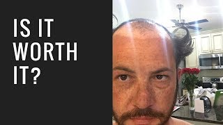 Hair Replacement Hair System Review Is It Worth It?