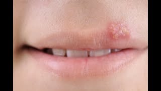 How to Get Rid of A Cold Sore Fast Overnight - Quick Cold Sore Treatment