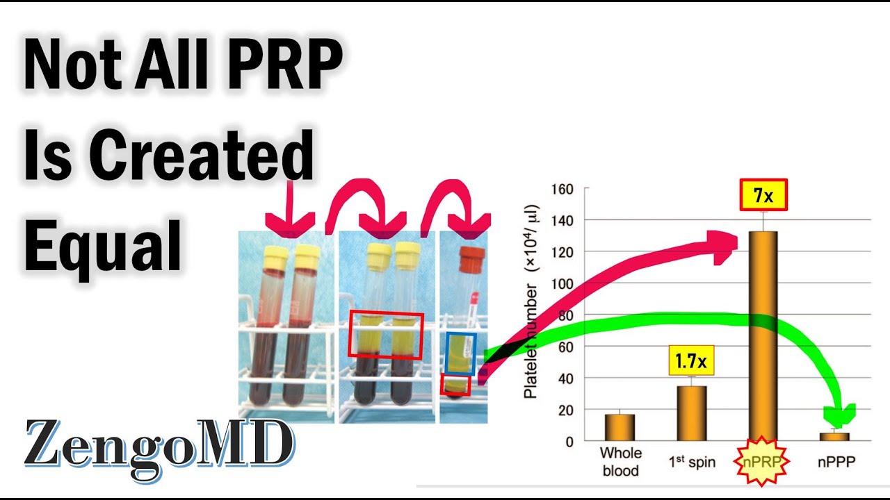 How is Proper Platelet-Rich Plasma (PRP) Prepared? -- ZengoMD