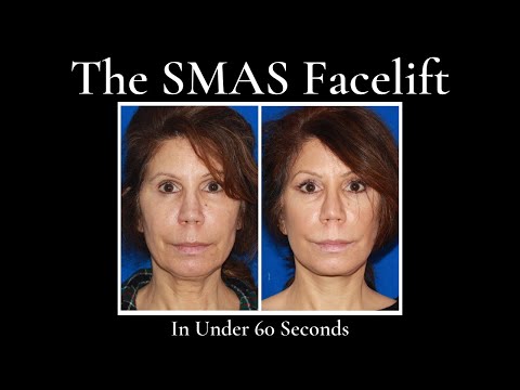 The SMAS Facelift (In Under 60 Seconds)